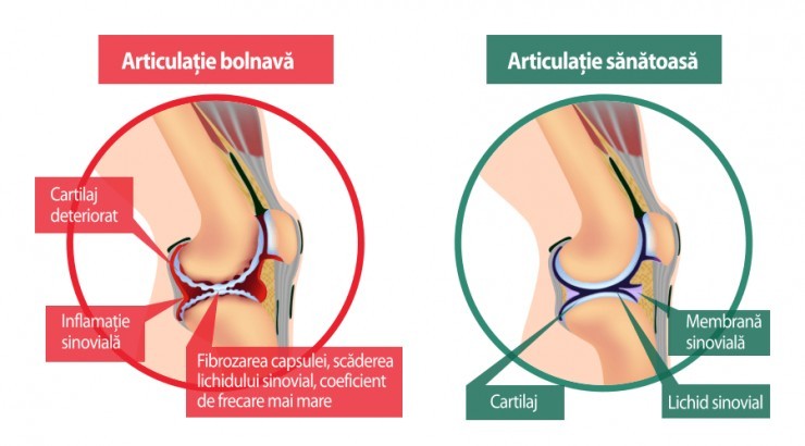 deteriorarea capsulelor articulare