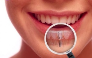Ce nu stiai despre tratamentul cu implant dentar