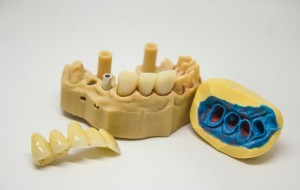 Periimplatita, o afecțiune ce pune în pericol succesul implantului dentar