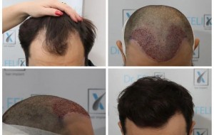 Dr. Felix Hair Implant - aflați aici despre implant de păr Q-FUE manual